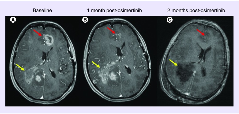 图1. MRI图像，详细介绍了奥西替尼治疗前后的情况。 （A）患者在开始进行奥西替尼治疗之前开始患有多灶性GBM，包括右侧顶叶肿瘤（黄色箭头）伴有卫星病变，以及左额叶的肿瘤（红色箭头）。 （B）osimertinib治疗1个月后，额叶病变几乎完全缓解，顶叶病变继续进展。 （C）该患者接受了进行性顶叶病变的切除，额叶病变中治疗效果稳定。